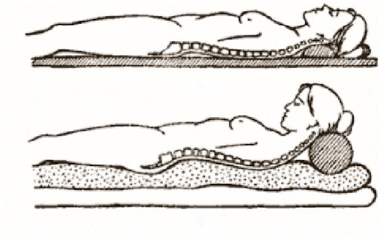 Osteochondrose -Figur