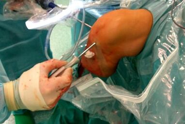 Chirurgische Intervention bei Arthrose