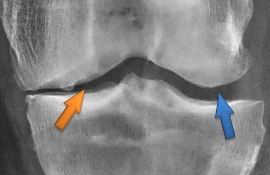 Kines Butapy für Arthrose