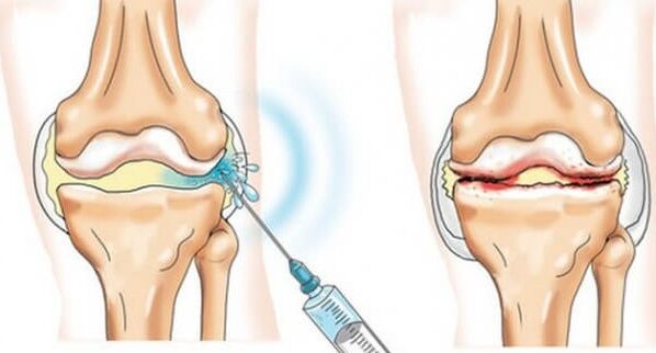 Medizinische Maßnahmen für Arthrose